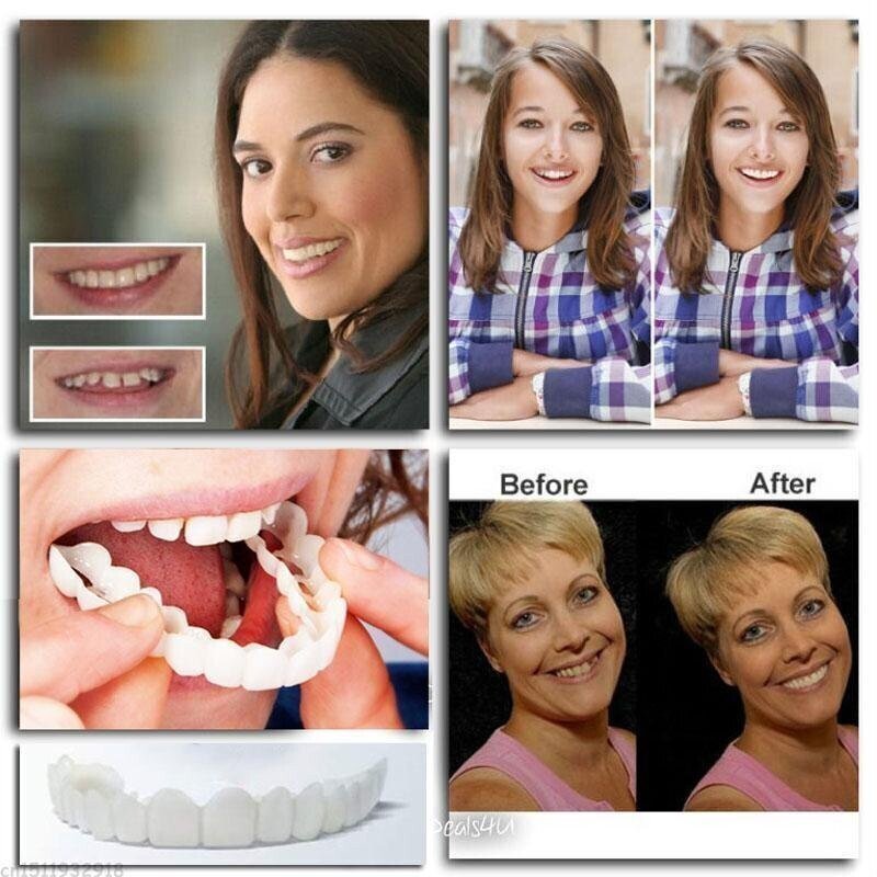 Guili | Adjustable Snap-On Dentures