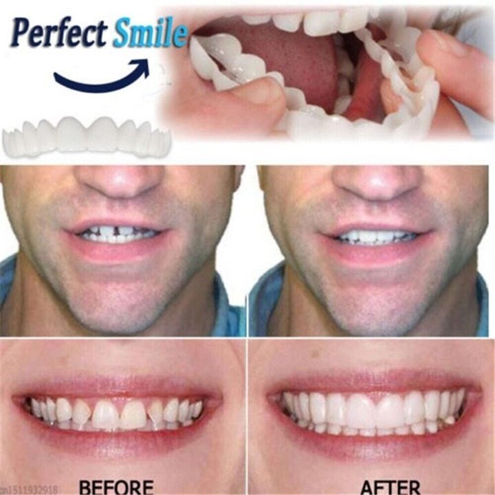 Guili | Adjustable Snap-On Dentures