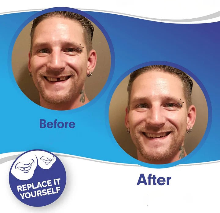 Guili | Removable Smile Veneers for Upper and Lower Teeth