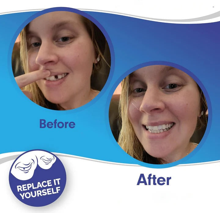 Guili | Removable Smile Veneers for Upper and Lower Teeth